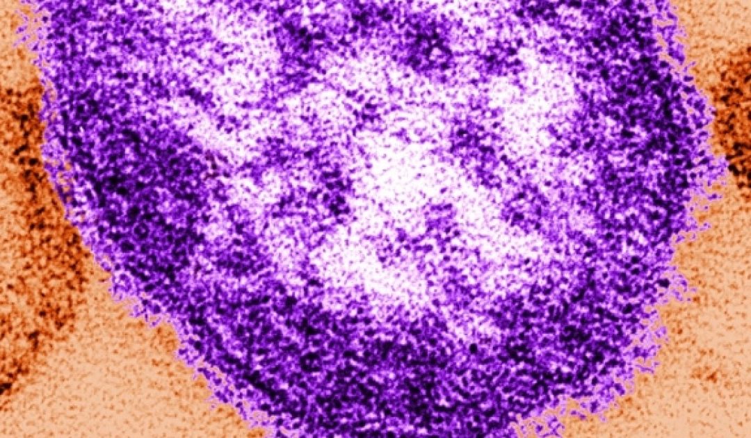 Oklahoma State Department of Health investigates suspected measles case – kjrh.com
