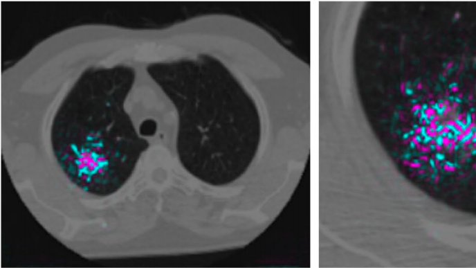 Google shows how AI might detect lung cancer faster and more reliably – MIT Technology Review