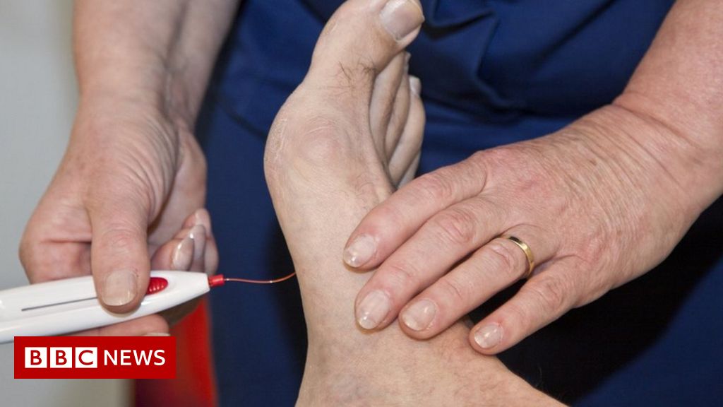 Fear over high rates of diabetes foot amputations