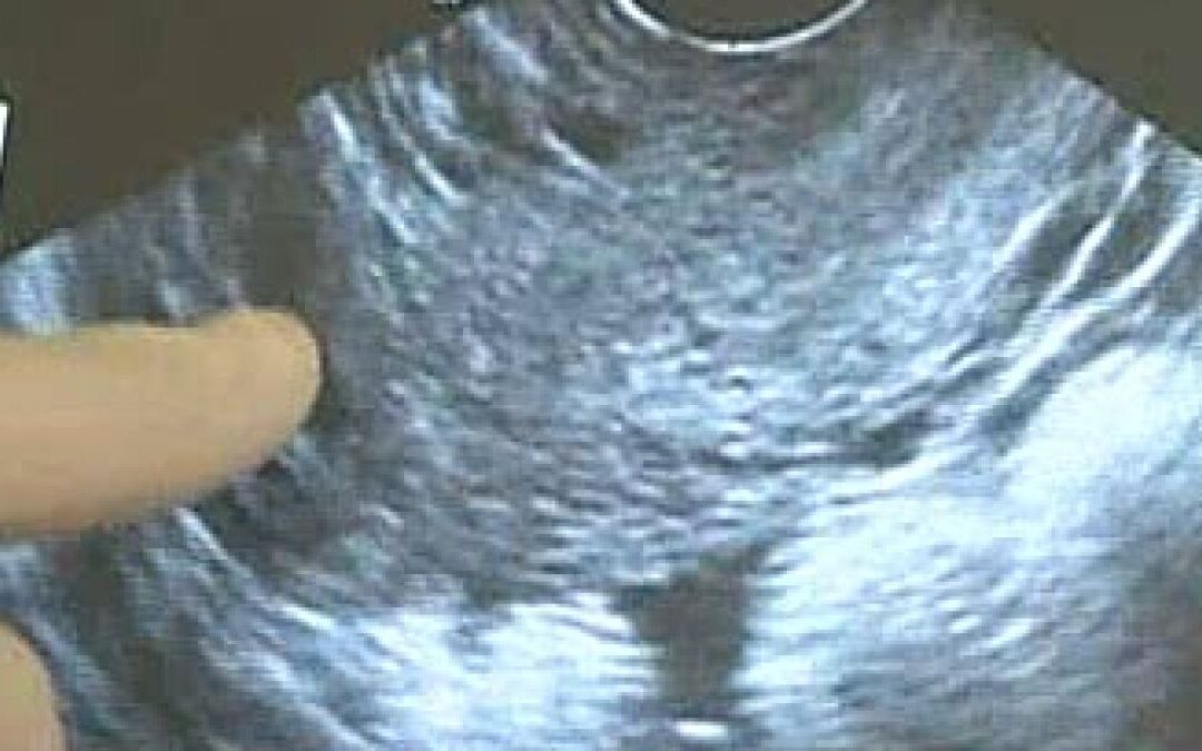 UK carries out first-ever womb transplant as sister donates uterus