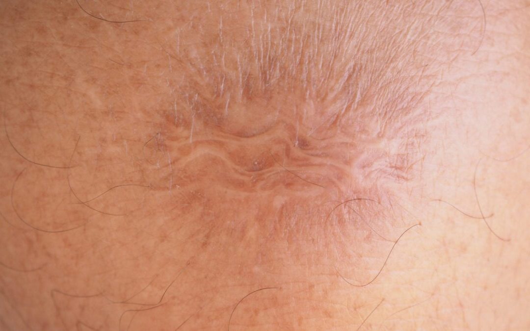Experimental Cream Could Make 'Permanent' Scars a Thing of the Past...